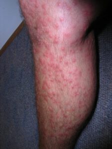 Swimmers Itch & Cercarial Dermatitis - Causes, Prevention, Treatment